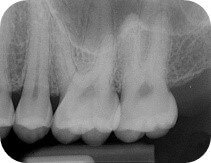 Periapical radiograph example