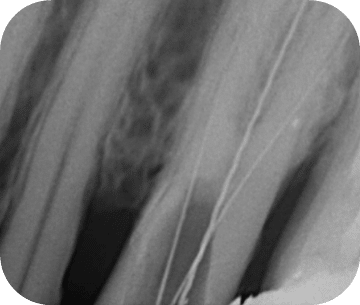 Distorted x-ray image