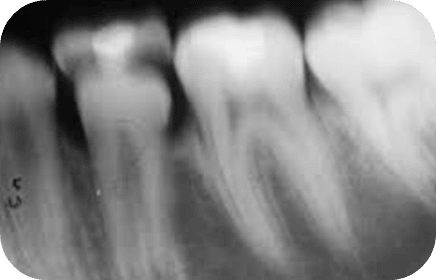 Blurred X-ray from movement