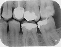 Bitewing radiograph example