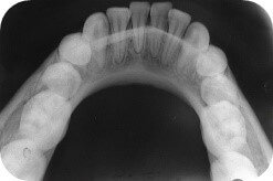Occlusal radiograph example