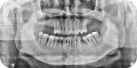 Panoramic radiograph example