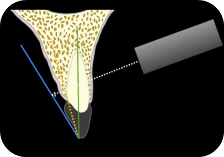 Aim X-ray beam (example 2)